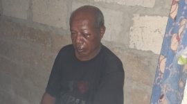 Wajah korban (Onisimus Boimau) babak belur akibat kekerasan yang dilakukan Tersangka Misraim Manggoa.
